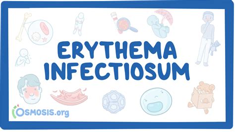 Erythema Infectiosum Fifth Disease Nursing Osmosis Video Library
