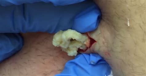 Epidermoid Cyst On Lower Back