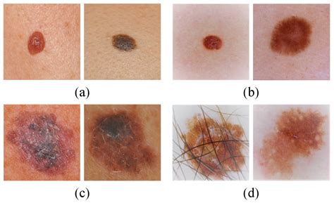 Early Melanoma Images Symptoms And Pictures