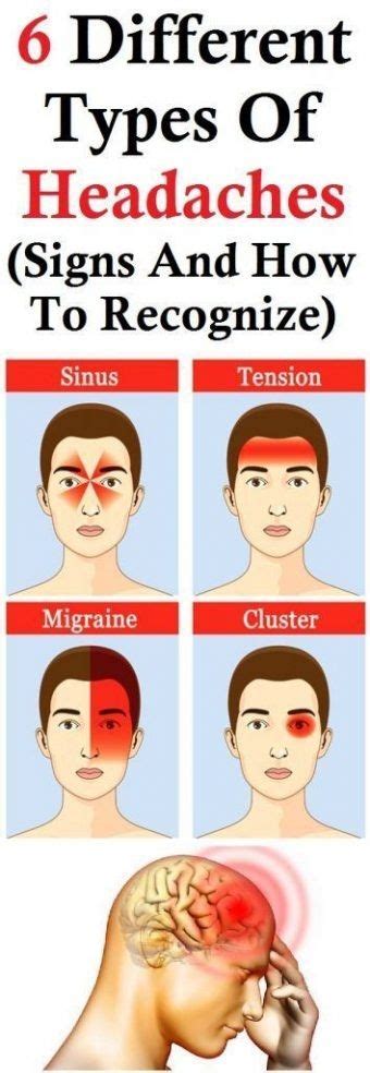 6 Different Types Of Headaches Signs And How To Recognize Headache