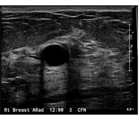 Figure 1 From Sonographic Evaluation Of Benign And Malignant Breast