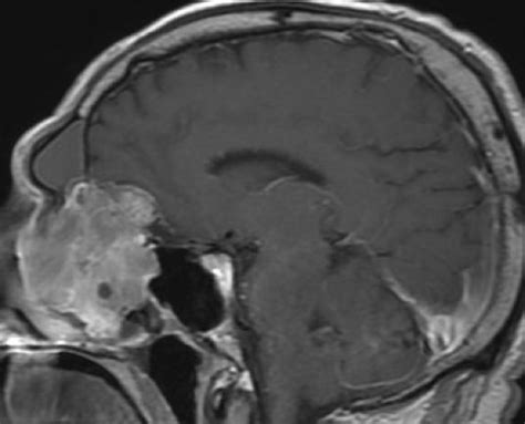 Esthesioneuroblastoma Papilloma And Osteoma Minimally Invasive Brain