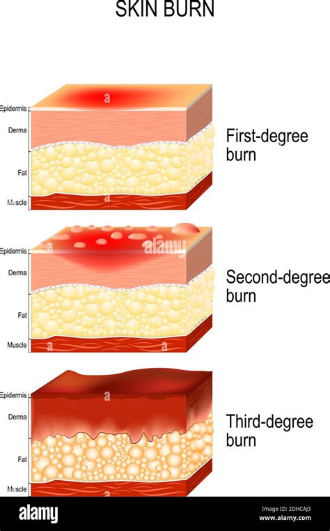 Third Degree Burn Medicine Hi Res Stock Photography And Images Alamy