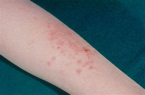 Global Health Petroleum Jelly May Reduce Risk Of Eczema