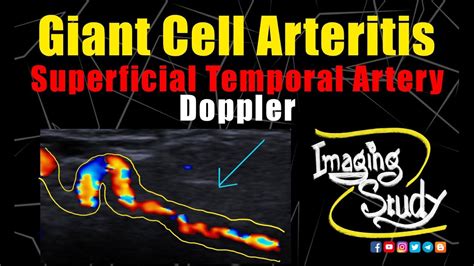 Giant Cell Arteritis Superficial Temporal Artery Doppler