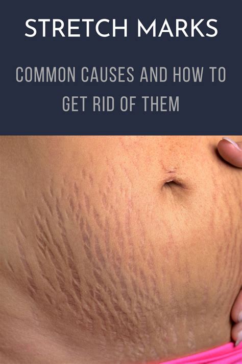Stretch Marks Common Causes And How To Get Rid Of Them