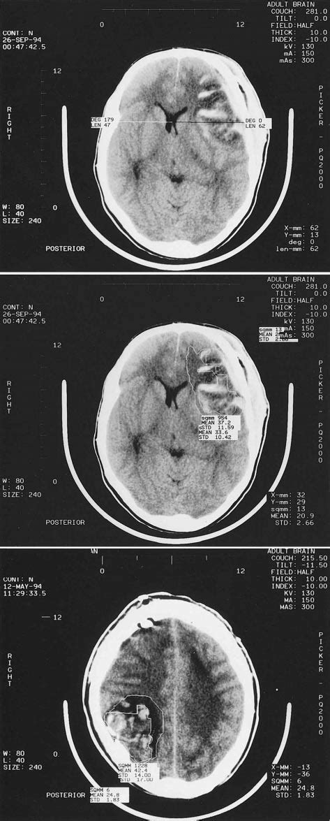Cerebral Contusions Di¨er From Intracerebral Hematomas They Have A