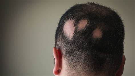 Alopecia Areata Hair Loss - Causes, Symptoms, and Treatments