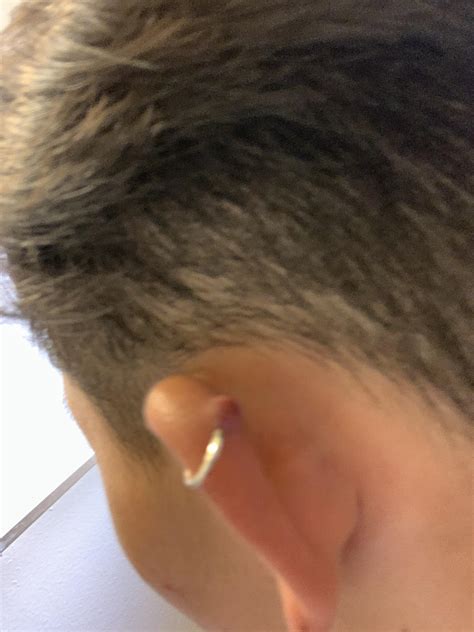 Help So I Have A Bump On My Cartilage And Its Been About A Year Now