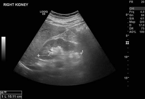 Fetal Horseshoe Kidney Ultrasound Horseshoe Kidney Transverse