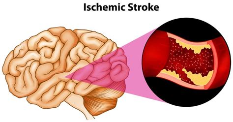 Acute Ischemic Stroke 2 Ceus Nurse Continuing Ed