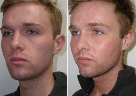 Cheekbone Implants Men Before And After