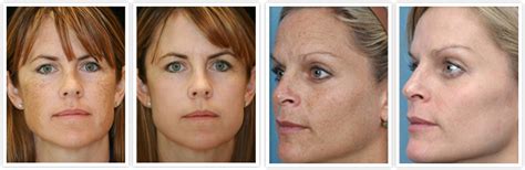 Photofacial Ipl The Derm Dermatologists In Cook County Il