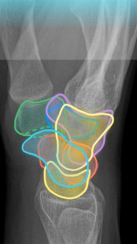 Lateral Wrist Xray Anatomy Quiz Video Radiology Imaging Radiology