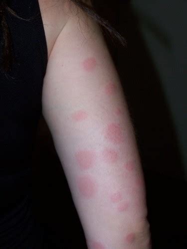Pictures Of Bed Bug Bites On Dogs Bed Bugs Big Bug Remedies Choose