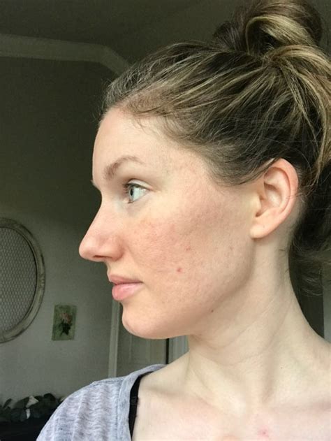 How I Cleared My Acne And Improved My Acne Scars Bekah Joy Blog