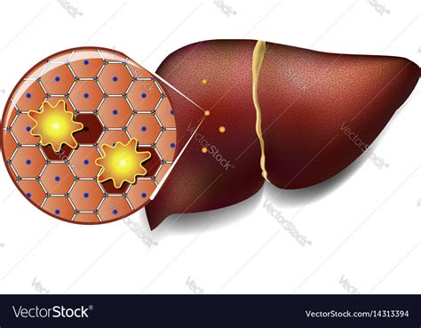 Liver Cells Attacked Toxins Royalty Free Vector Image