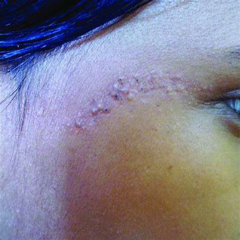 D Multiple Yellowish Papules And Plaques Distributed On The