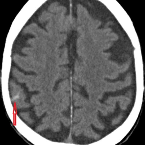 Noncontrast Computed Tomography Scan Of The Head Axial View Showing