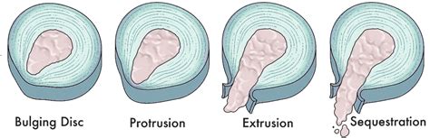 Types Of Disc Herniation