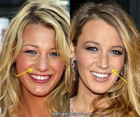 Blake Lively Before And After Breast Implants