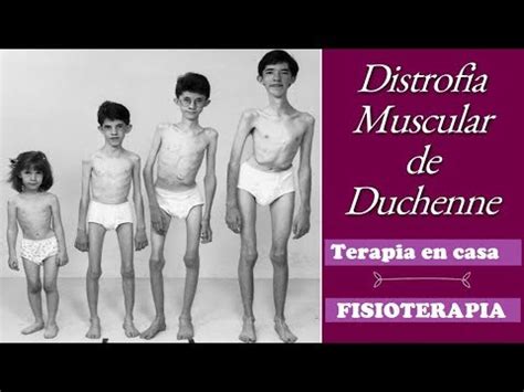 Distrofia Muscular De Duchenne Indicaciones Terapia En Casa Youtube