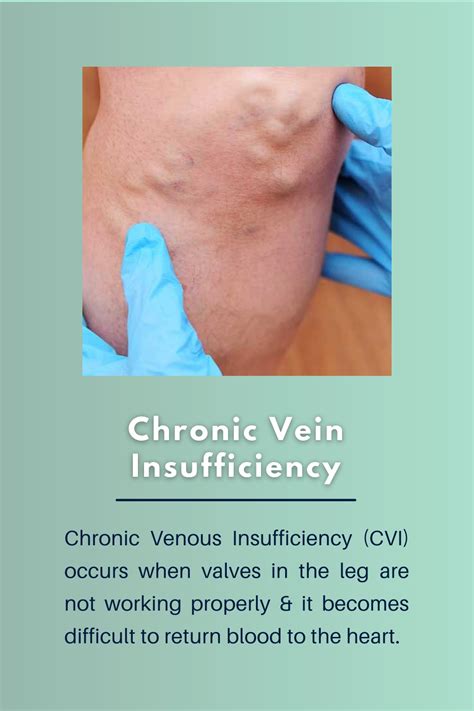 Ppt Chronic Vein Insufficiency Its Symptoms And Treatments Powerpoint