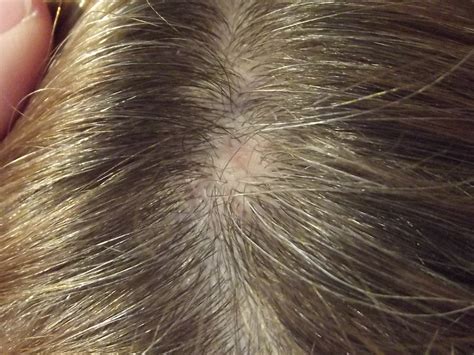 I Have Had A Painless Lump On My Scalp For Several Months