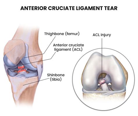 Acl Injuries Nj S Top Orthopedic Spine And Pain Management Center
