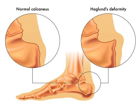 How To Quickly Fix A Haglund S Deformity