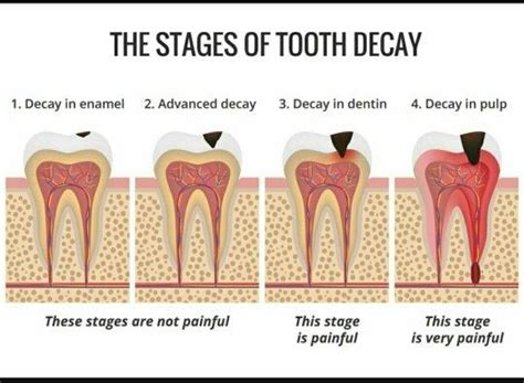 A cavity is a hollow in an object. I have been diagonsed with a tooth cavity.How long will ...