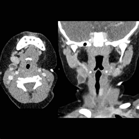 Second Branchial Cleft Cyst Pediatric Radiology Reference Article