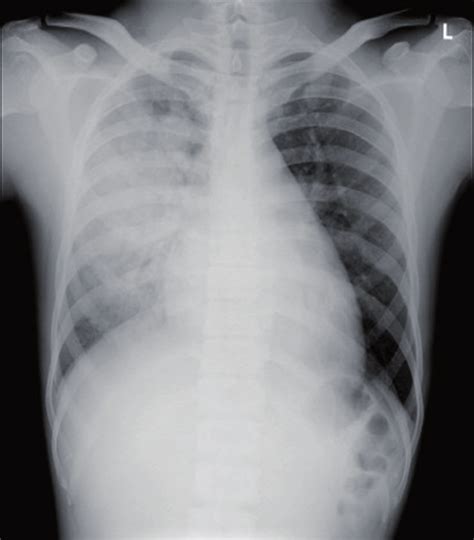Interstitial Edema Chest X Ray
