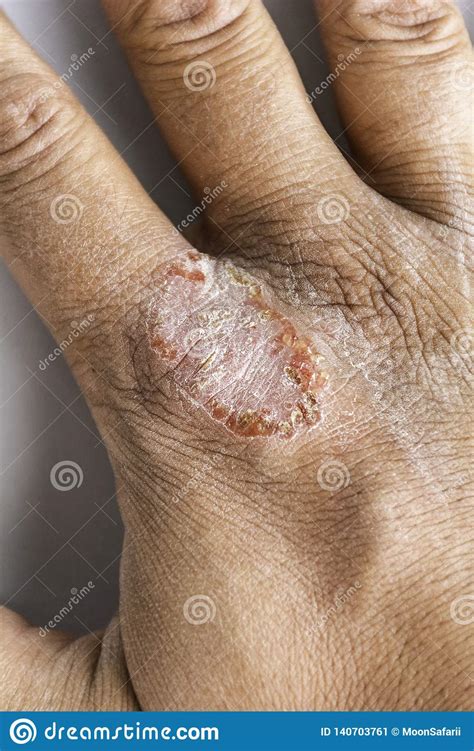 Hand With Atopic Dermatitis Eczema Psoriasis Vulgaris Stock Image