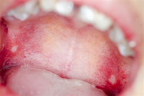 Causes For Bumps On The Roof Of Your Mouth Part