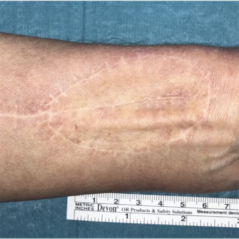 Split Thickness Skin Graft 35 Months Post Surgery Download