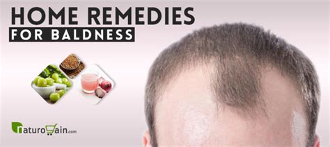 9 Best Home Remedies For Baldness To Prevent Hair Loss Naturally