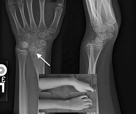 Madelungs Deformity Hand Surgery Resource