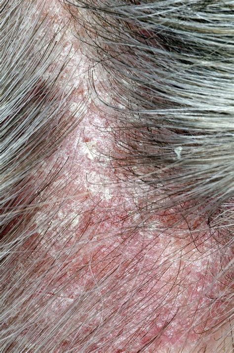 Psoriasis On The Scalp Stock Image C Science Photo Library
