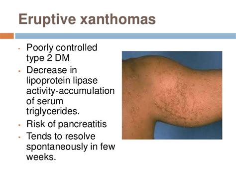 Cutaneous Manifestations Of Endocrine Disease