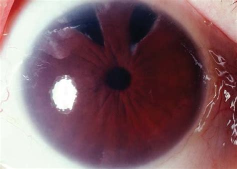 Aphakic Right Eye With Operable Bullous Keratopathy Shown By The