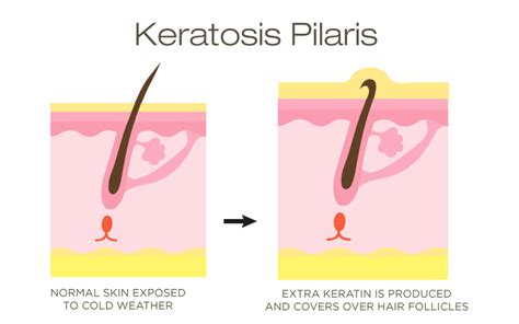 What Is Keratosis Pilaris