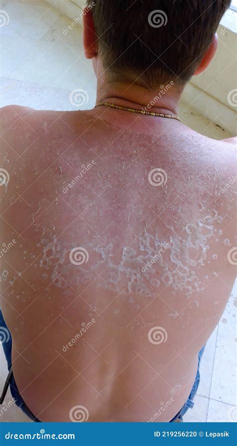 Sunburn On The Back And Neck Of A Man Skin Peeling And Peeling Red