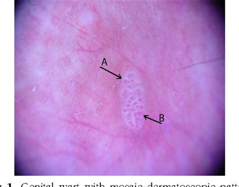 Figure 3 From Dermatoscopy Of Genital Warts Semantic Scholar