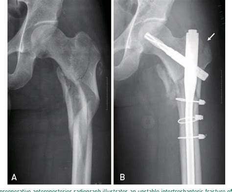 Pdf Radiographic Outcomes Of Osteosynthesis Using Proximal Femoral