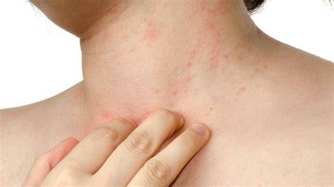 Dermatite Atopica Cos Cause E Cure