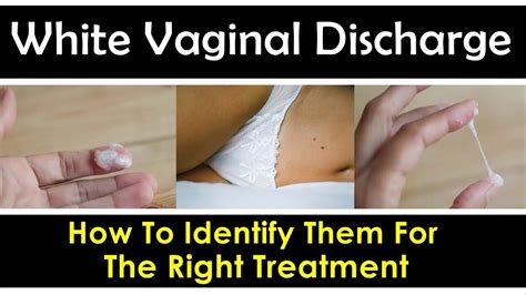 Causes Of White Vaginal Discharge Best Ways To Identify Them Youtube