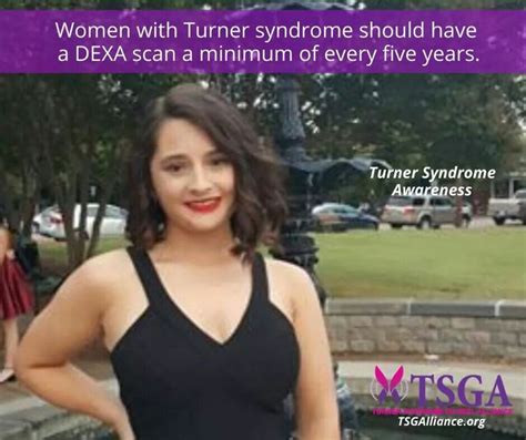 Pin On Turner Syndrome