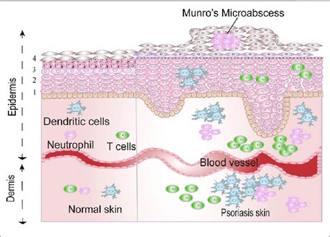 The Differences Between Normal Skin And Psoriatic Skin The Epidermis