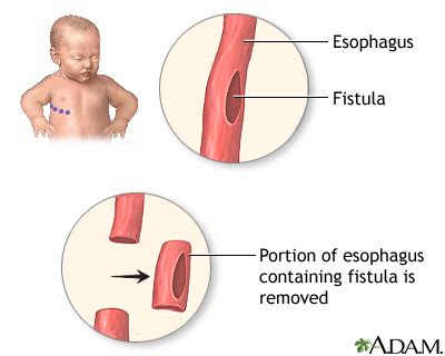 Tracheoesophageal Fistula And Esophageal Atresia Repair Multimedia